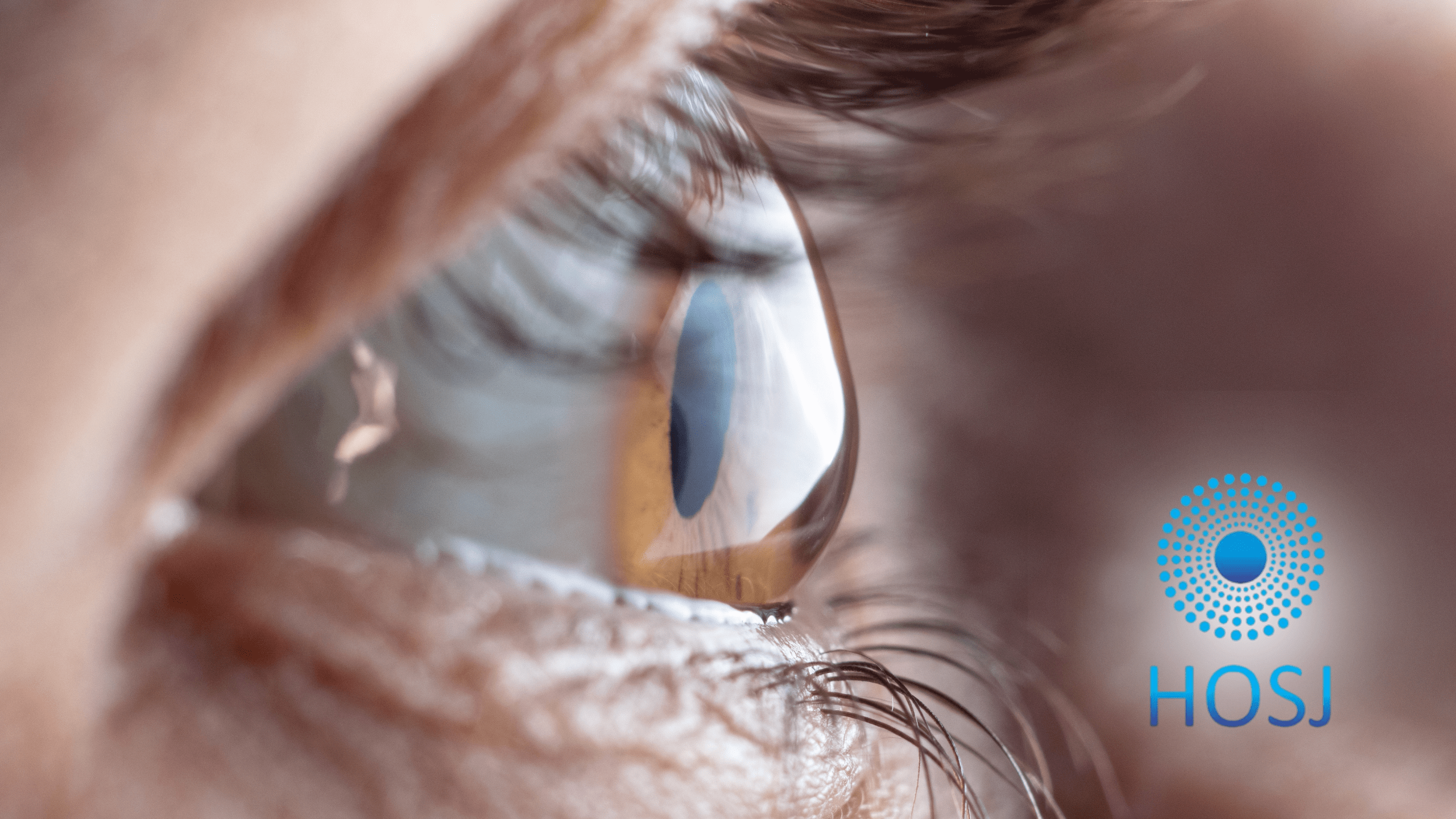 Coçar os olhos pode causar ceratocone? Entenda os riscos para a sua visão